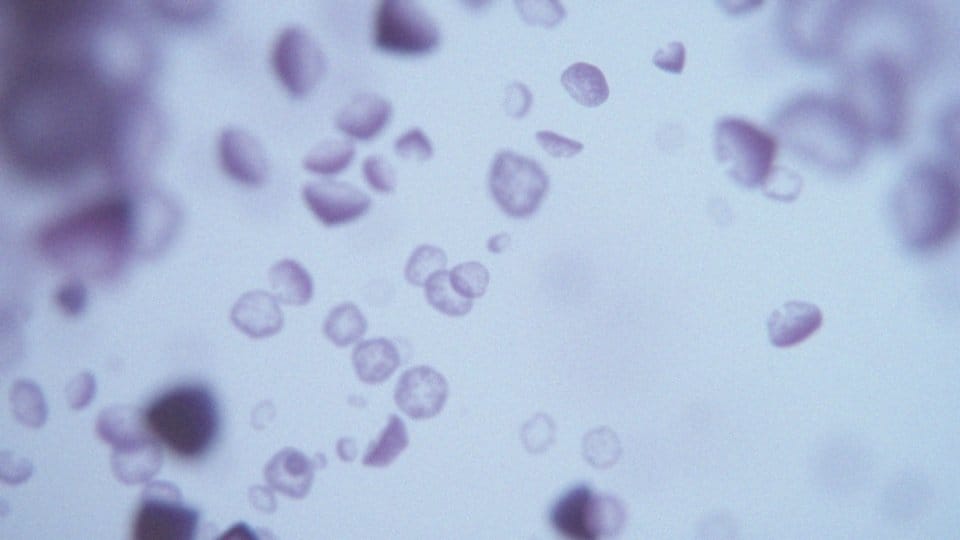 Co oznacza wzrost stężenia tryptazy?